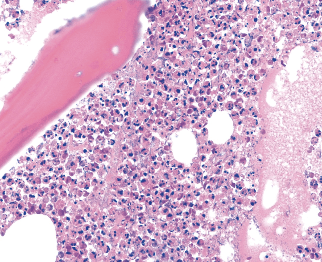 Histopathology of proximal margin bone biopsy showing acute inflammation and osteomyelitis