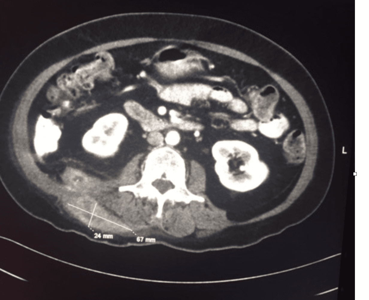 Actinomycosis case image 1