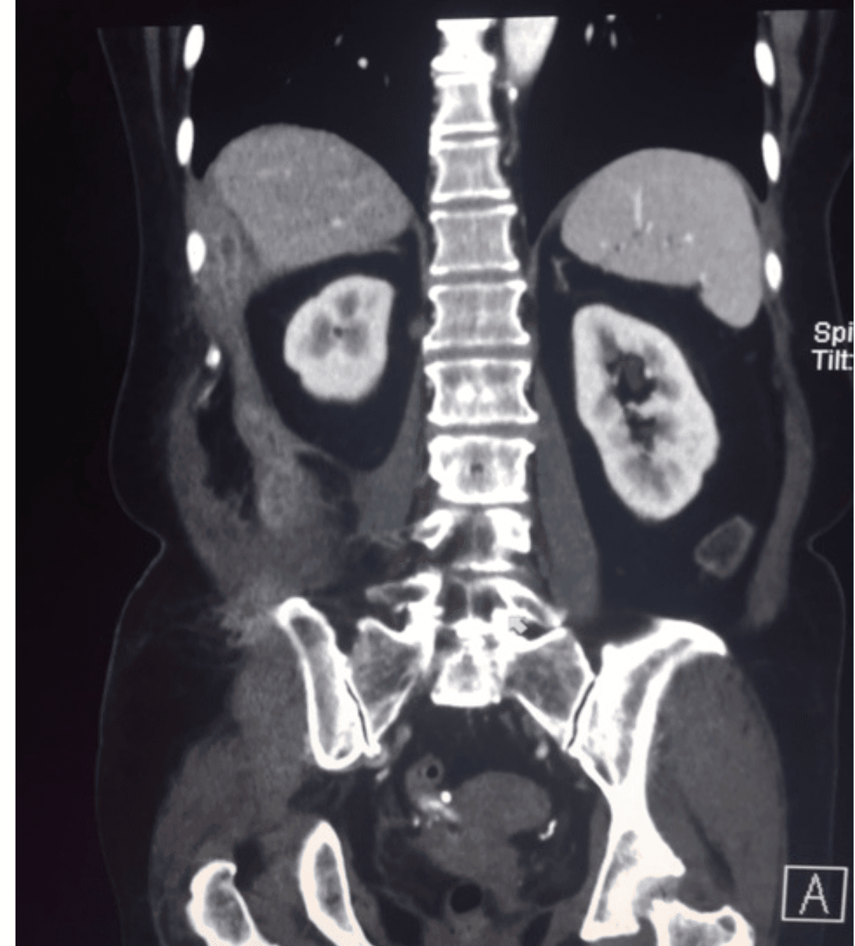 Actinomycosis case image 2