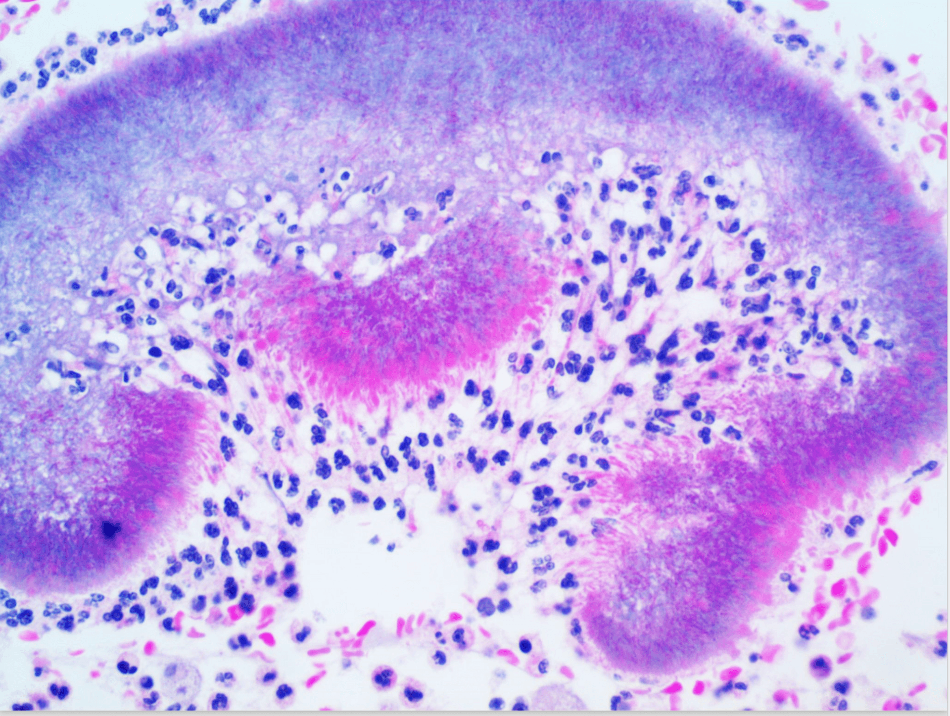 Actinomycosis case image 3