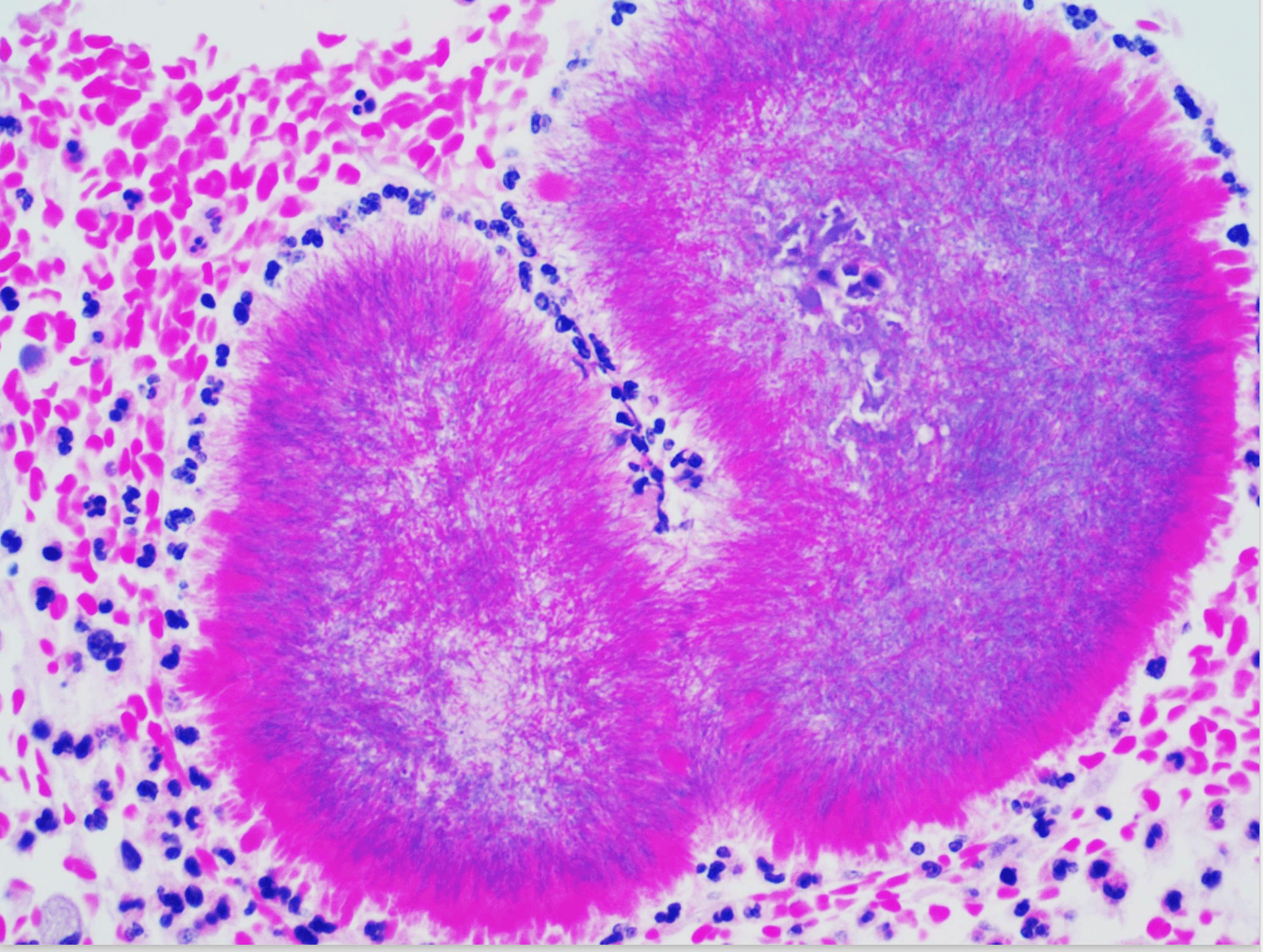 Actinomycosis case image 4