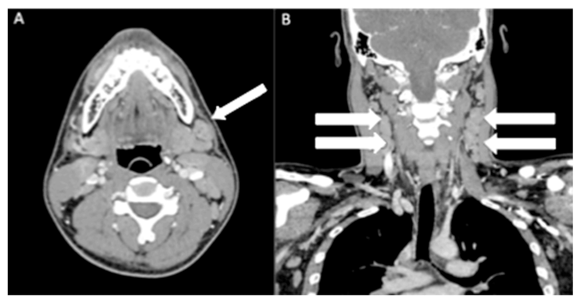 Contrast-enhanced CT of the neck in axial and coronal planes demonstrating multiple bilateral enlarged cervical lymph nodes (arrows), the largest measuring 2.4 cm, without central necrosis or matted appearance.