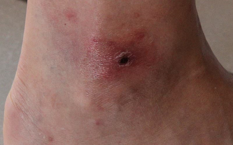 Necrotic eschar on the leg with a dark crusted center and surrounding erythema, typical of African tick-bite fever