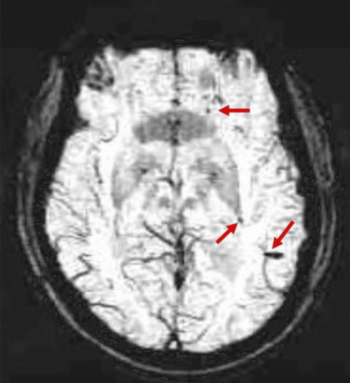 Susceptibility-weighted MRI showing multiple microbleeds as hypointense foci over bilateral cerebral and cerebellar hemispheres in a patient with Angiostrongylus cantonensis eosinophilic meningitis