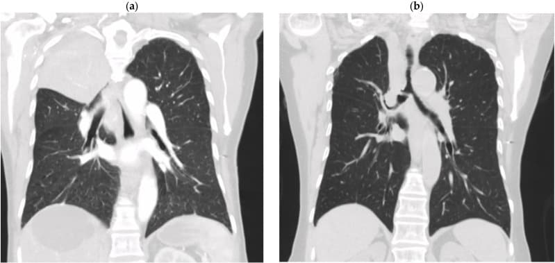 Coronal chest CT showing dense right-sided consolidation and mediastinal lymphadenopathy before and after treatment