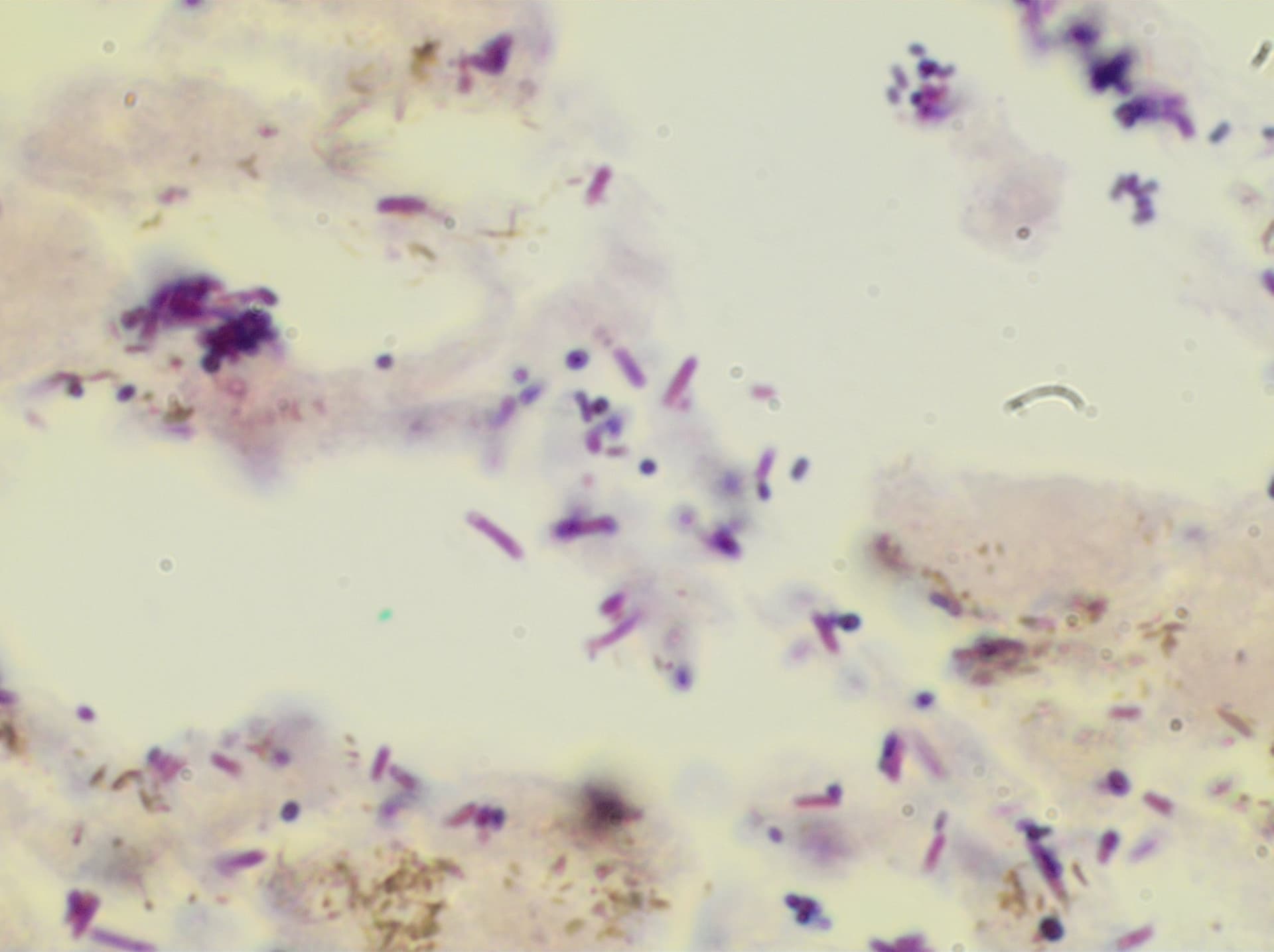 Gram stain of a positive blood culture demonstrating gram-negative rods and gram-positive cocci in polymicrobial bacteremia