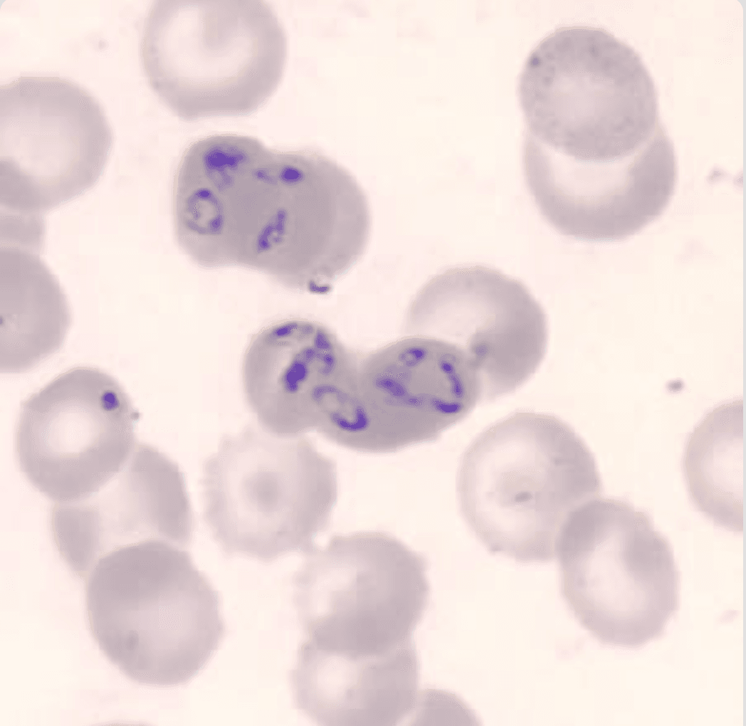 Peripheral blood smear showing small intraerythrocytic ring forms with multiple parasites per erythrocyte and extracellular ring forms consistent with Babesia microti