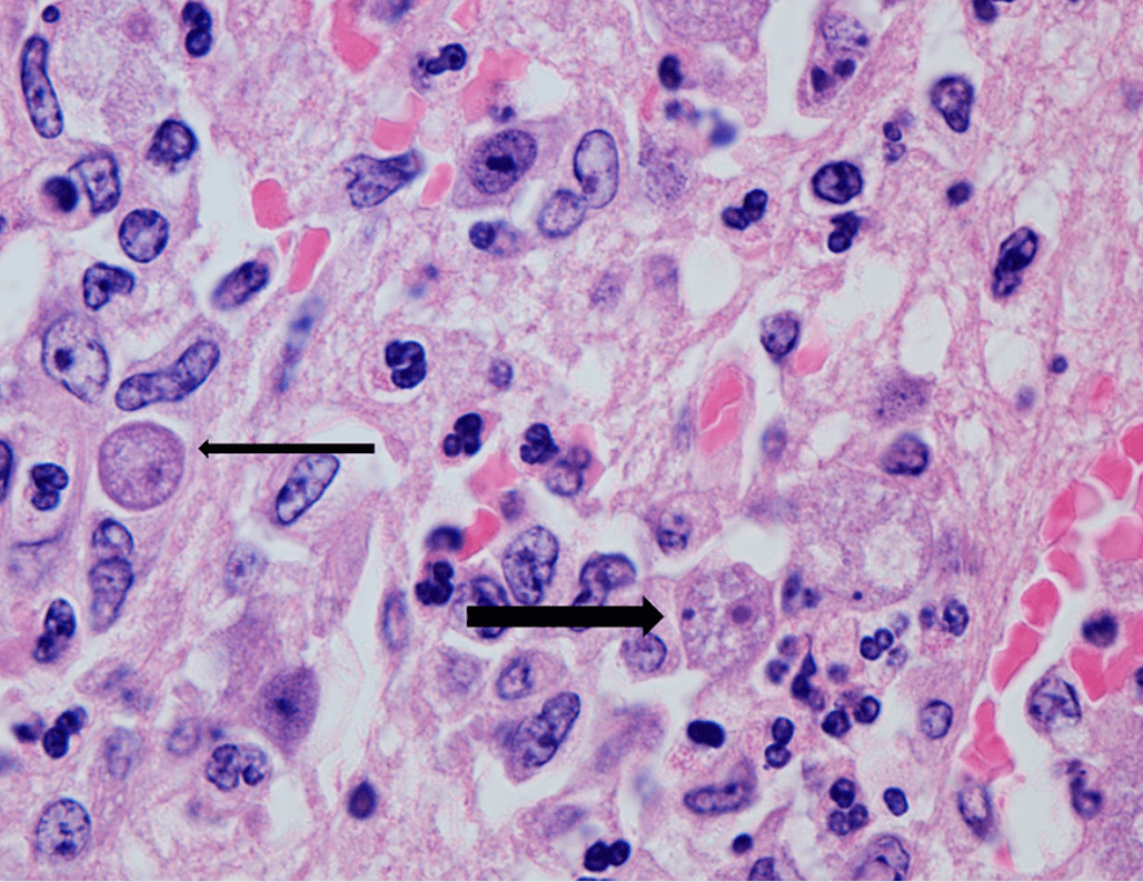 Brain tissue stained with hematoxylin and eosin showing Balamuthia mandrillaris cysts in the neuropil with a thick outer wall and dense internal staining