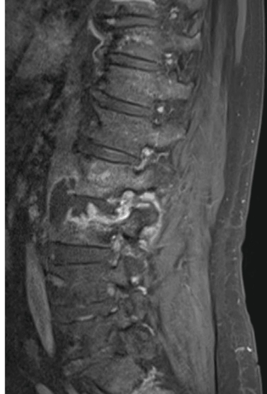Sagittal lumbar spine MRI showing abnormal signal centered at L2-L3 with surrounding inflammatory change and an adjacent paravertebral collection
