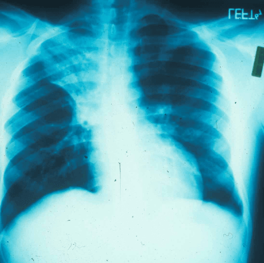 Chest X-ray showing a right upper lobe cavitary opacity with surrounding consolidation