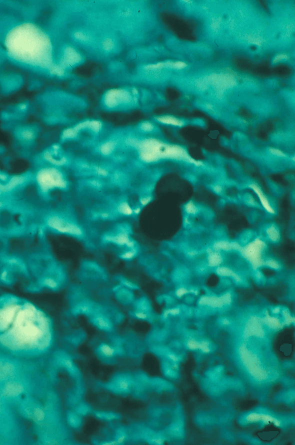 Grocott methenamine silver stain showing broad-based budding yeast