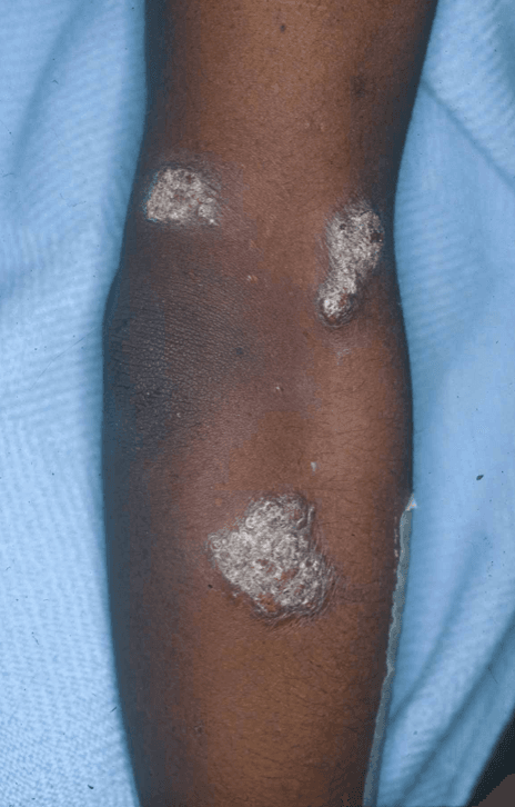 Large verrucous blastomycosis lesion over the left arm