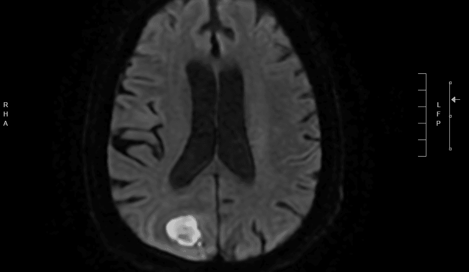 Diffusion-weighted MRI showing restricted diffusion within a right parietal ring-enhancing lesion