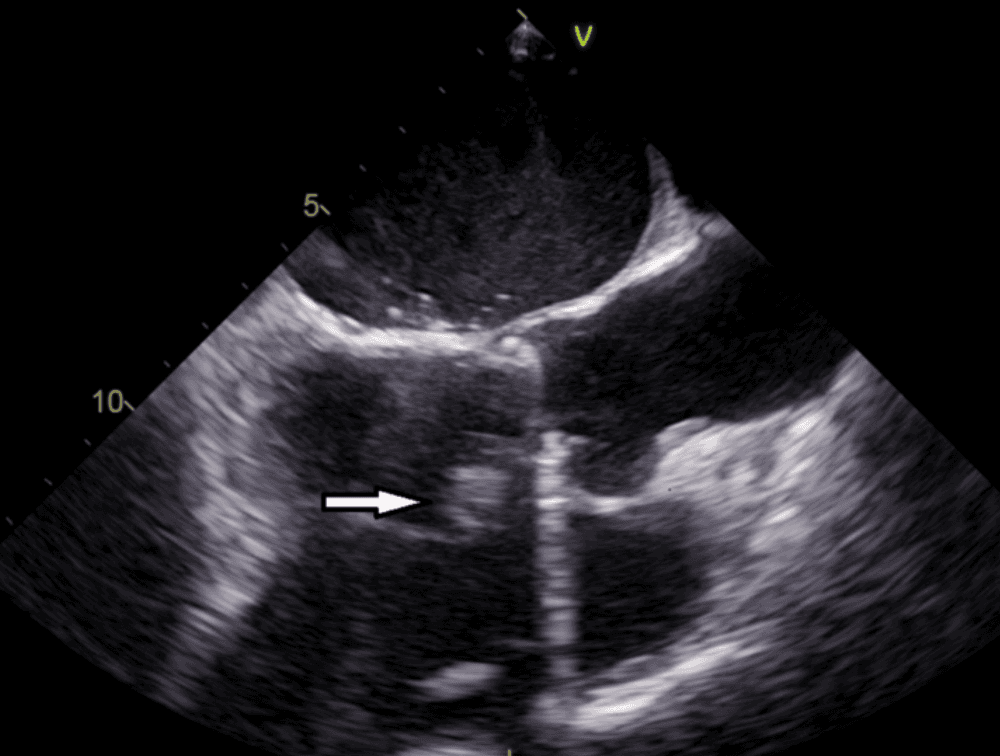 Echocardiogram showing an aortic valve vegetation