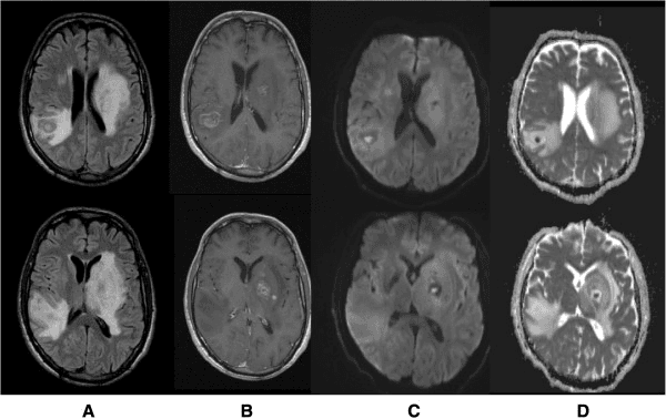Brain MRI showing multiple ring-enhancing Candida abscesses in the basal ganglia and right parietal white matter
