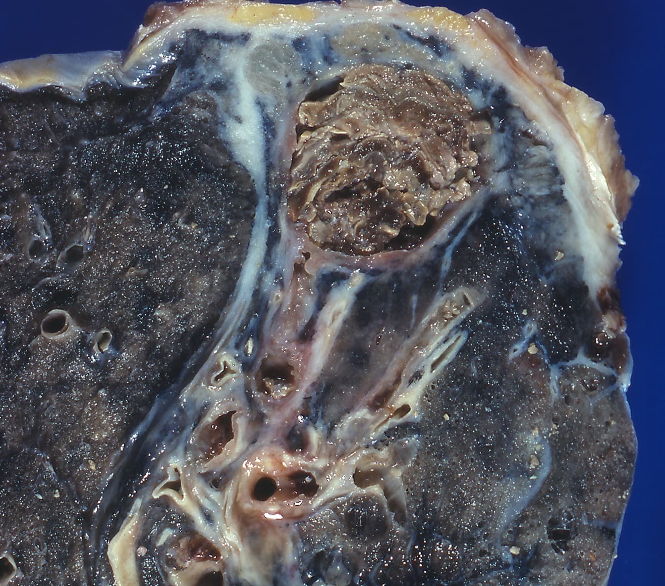 Gross pathology of a pulmonary aspergilloma (fungal ball) lying free within an old tuberculous cavity