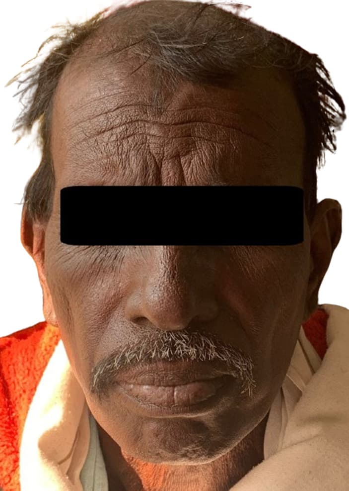 Generalized reddish-brown to black hyperpigmentation of the face in a patient receiving clofazimine for MDR-TB