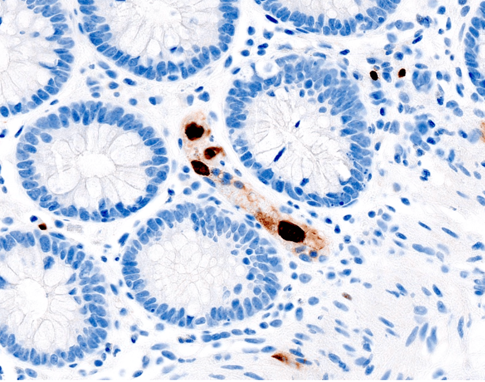 Colonic mucosal biopsy immunohistochemistry showing enlarged cell with intranuclear inclusion