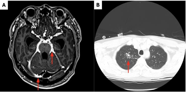 Axial T1 post-contrast brain MRI demonstrating leptomeningeal enhancement in the basal cisterns