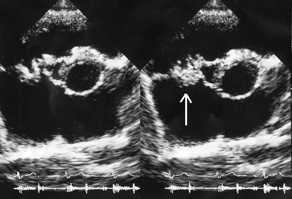Echocardiogram demonstrating a valvular vegetation
