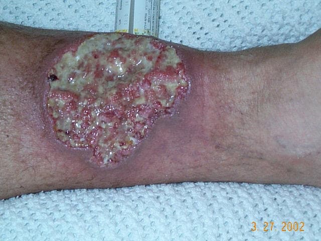 Lower leg ulcer with surrounding erythema and violaceous undermined borders in a patient with Crohn disease