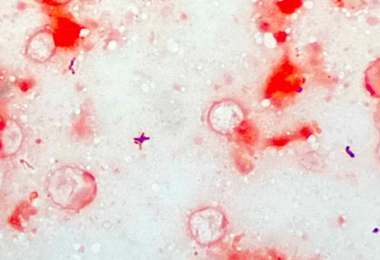 Gram stain of synovial fluid showing gram‑positive rods
