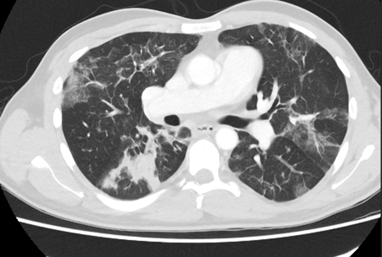 Axial CT chest showing bilateral peripheral ground-glass and consolidative opacities