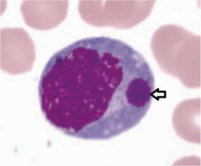 Wright stain of peripheral blood smear showing a monocyte with an intracytoplasmic basophilic inclusion