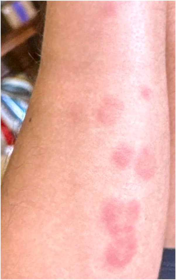 Erythematous edematous papules and nodules on the upper extremity