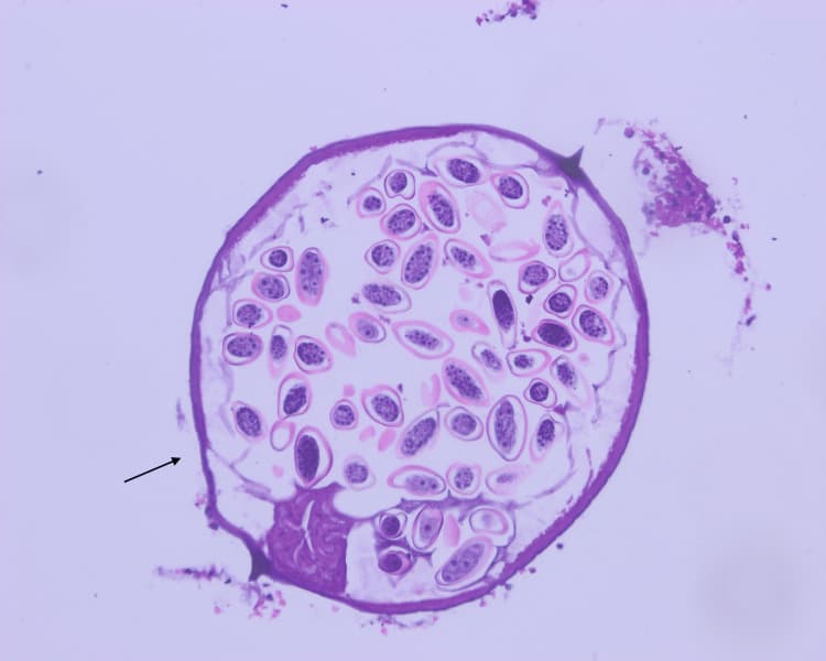 H&E stain of appendiceal lumen contents demonstrating a nematode with a thin cuticle and lateral projections