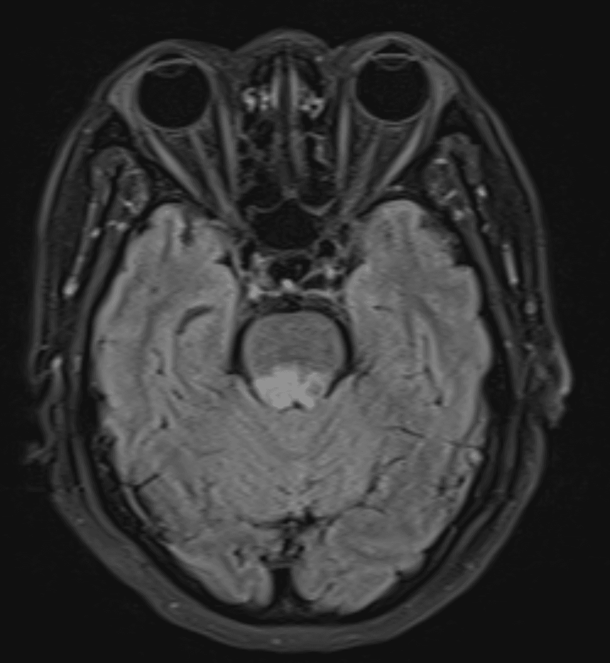 MRI brain T2/FLAIR sequence showing hyperintensity in the dorsal medulla, posterior pontine tegmentum, and bilateral dentate nuclei consistent with enterovirus A71 rhombencephalitis