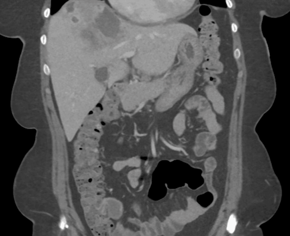 Coronal CT abdomen showing hepatomegaly with hypodense migratory lesions in fascioliasis