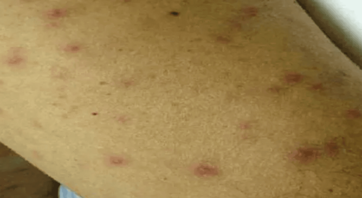 Maculopapular rash on the trunk in flea-borne typhus