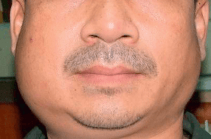 Mandibular edema from cutaneous gnathostomiasis