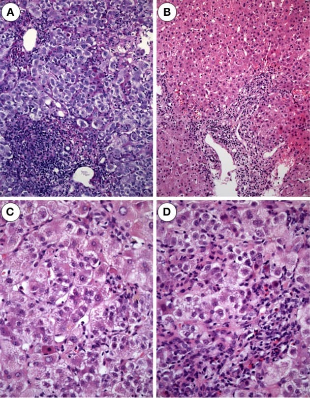 H&E stained liver biopsy showing portal expansion with mixed inflammatory infiltrate and hepatocellular ballooning