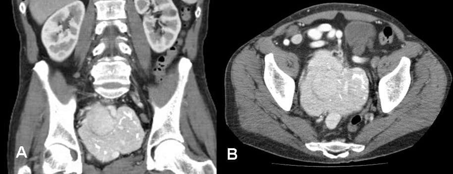 CT scan of the abdomen demonstrating a large enhancing retroperitoneal mass with intratumoral calcifications