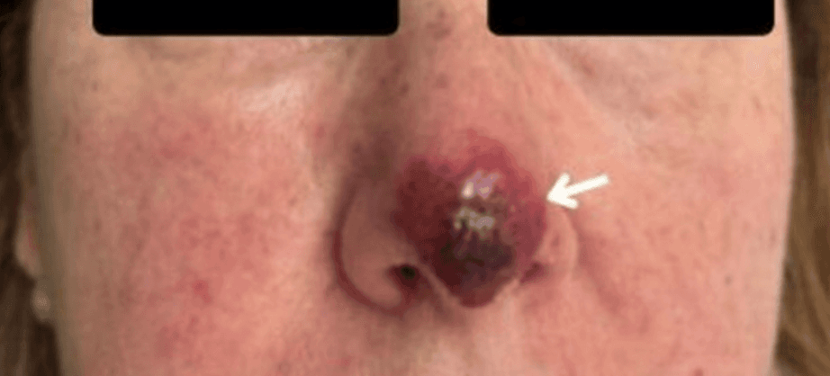 Facial herpes zoster with Hutchinson's sign