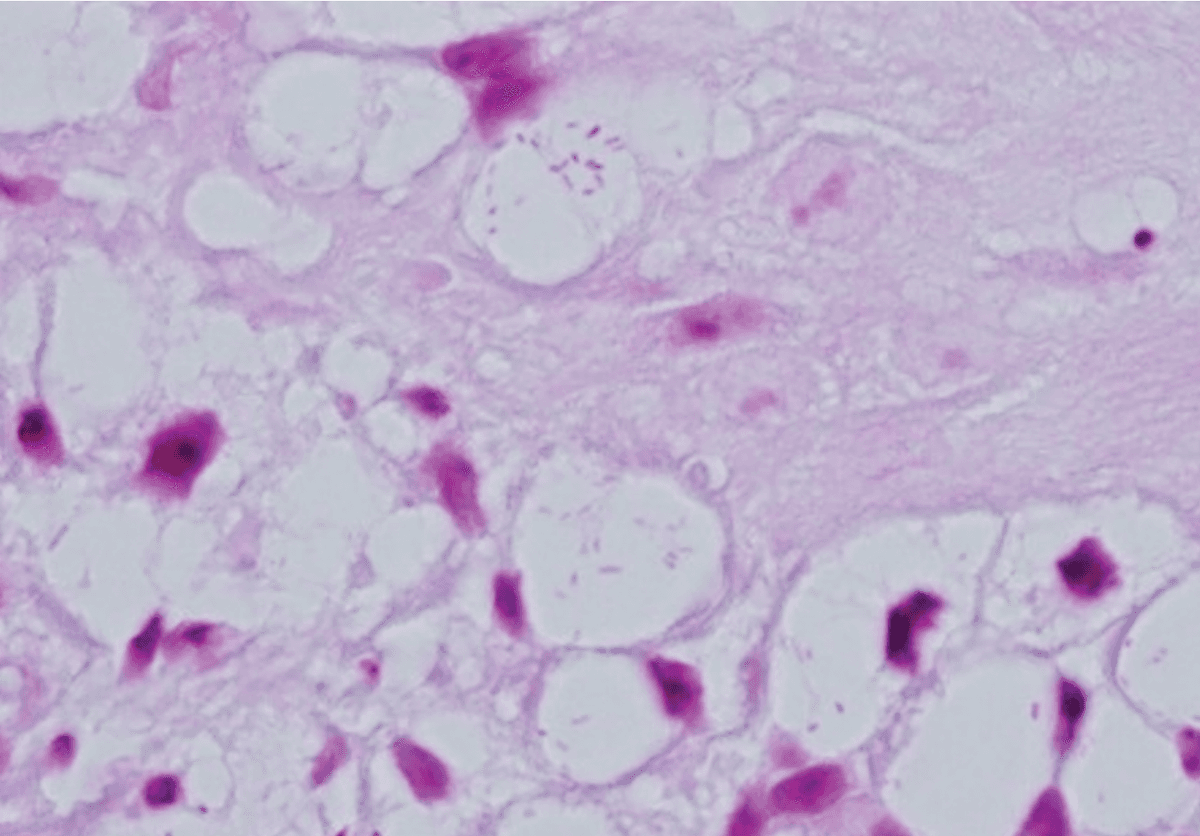 Gram-negative bacilli within the cytoplasm of Mikulicz cells