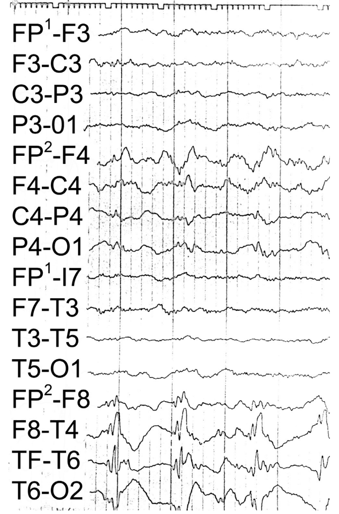 Electroencephalogram demonstrating left temporal periodic lateralized epileptiform discharges in La Crosse virus encephalitis