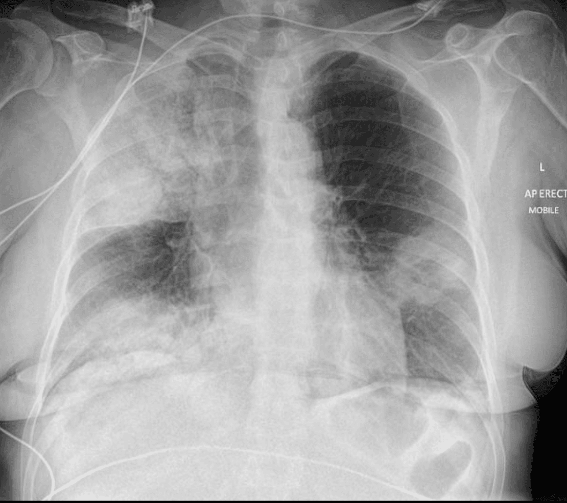 Chest radiograph showing multilobar pneumonia