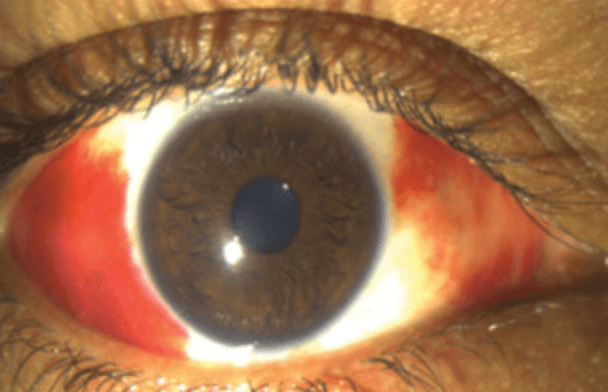 Conjunctival suffusion in a patient with leptospirosis
