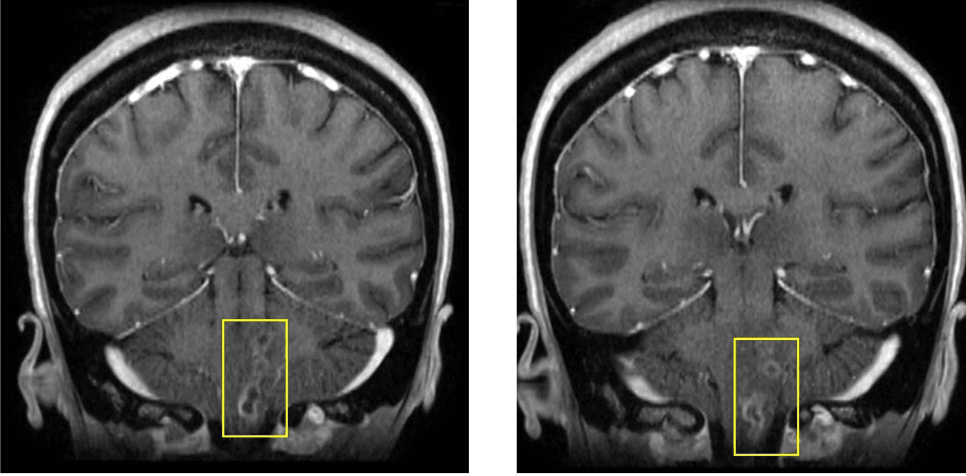 Contrast-enhanced brain MRI showing multifocal abscesses spanning the medulla and dorsal pons