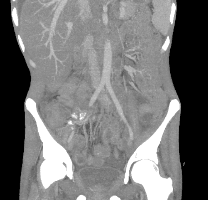 Coronal abdominal CT showing extensive abdominal and pelvic lymphadenopathy with ileocecal pathology
