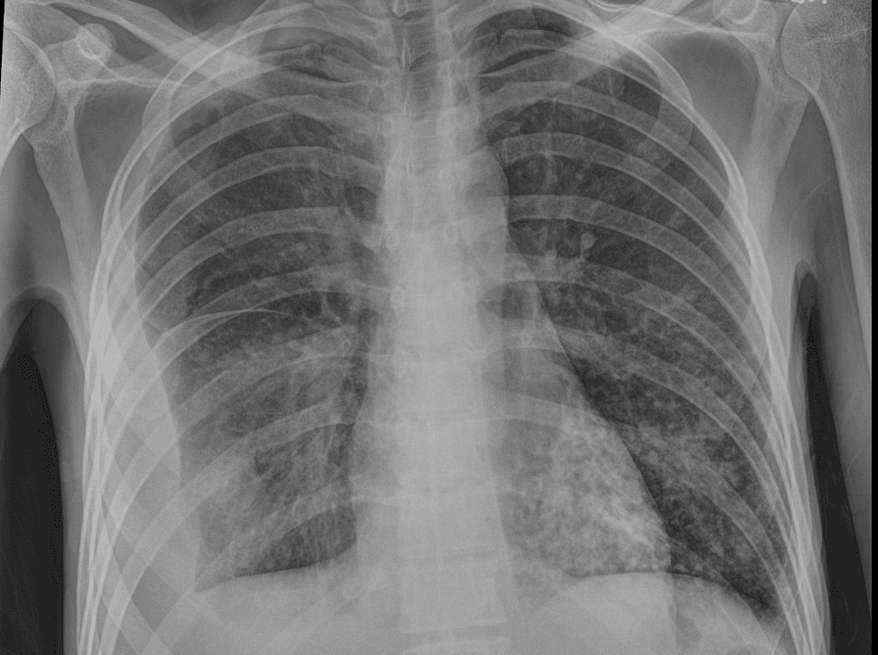 Chest radiograph showing bilateral patchy pulmonary opacities and right pleural effusion