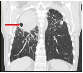 Coronal chest CT showing right upper lobe cavitary lesion with bilateral nodular silicotic changes