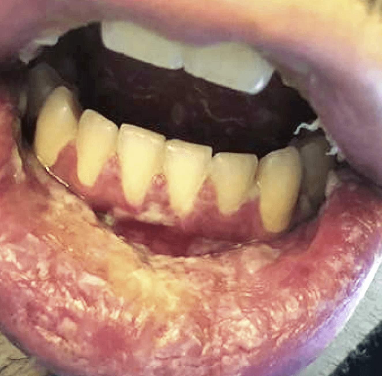Oral mucositis with hemorrhagic lip crusting in a patient with reactive infectious mucocutaneous eruption