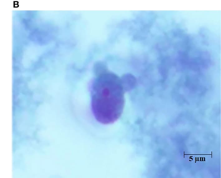 Trichrome-stained cerebrospinal fluid specimen demonstrating trophozoites with a prominent central karyosome