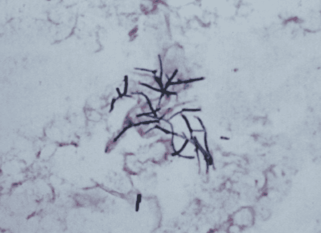Gram stain showing branching Gram-positive rods consistent with Nocardia