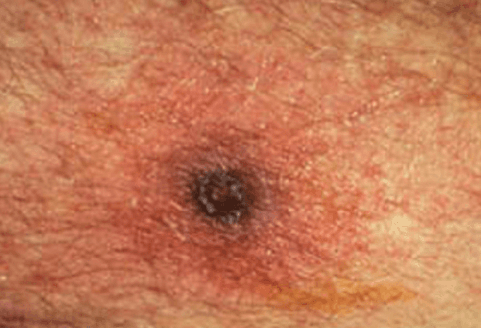 Scrub typhus eschar: a painless necrotic ulcer with a black crust and surrounding erythema at the site of chigger bite