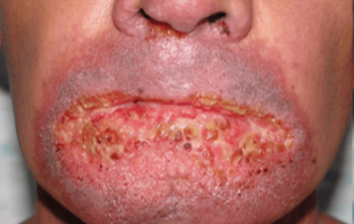 Granular vegetating ulceration of the lips and oral mucosa with a mulberry-like surface and hemorrhagic dots, consistent with moriform stomatitis of paracoccidioidomycosis